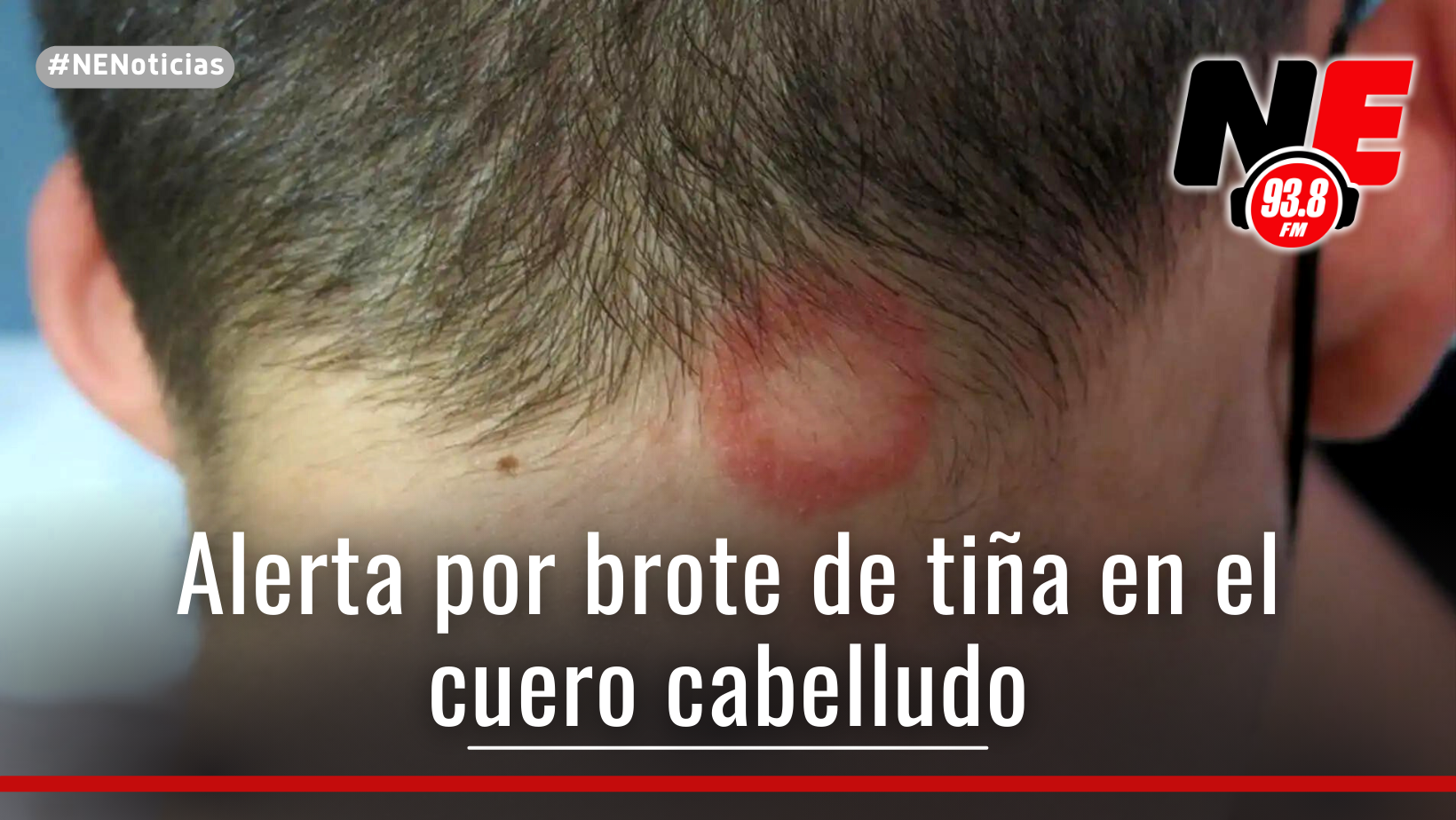 ¿Cómo se contrae el brote de tiña? la infección en el cuero cabelludo ...